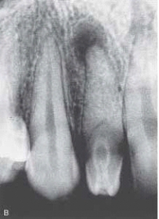 <strong> This radiograph clearly shows which developmental anomaly?</strong> A) Dens in dente B) Periapical (PAP) C) Caries D) Open contacts