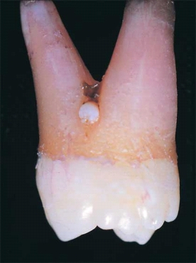 <strong> The projection of white material seen at the furcation area in this maxillary molar is a developmental anomaly. You suspect</strong> A) dens evaginatus. B) enamel pearl. C) supernumerary cusp. D) calculus.