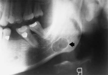 <strong> The pseudocyst seen in this radiograph is surrounded by salivary gland tissue. It is a/an:</strong> A) simple bone cyst. B) Stafne bone cyst. C) traumatic bone cyst. D) aneurysmal bone cyst.