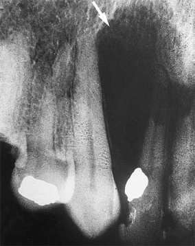 <strong> The pear-shaped radiolucency observed in this radiograph is most likely a:</strong> A) radicular cyst. B) lateral periodontal cyst. C) globulomaxillary cyst. D) nasopalatine canal cyst.
