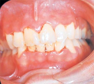 <strong> The gingivae are painful and erythematous. The interdental papillae appear as punched-out, necrotic, cratering areas. The overall sloughing of the necrotic tissue appears as a pseudomembrane over the tissues. The patient experiences a foul odor and metallic taste. On the basis of these features you suspect that this patient has:</strong> A) acute marginal gingivitis. B) primary herpes infection. C) necrotizing ulcerative gingivitis. D) pseudomembranous candidiasis.