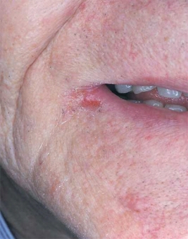 <strong> This lesion in the commissure is most likely caused by Candida albicans or a nutritional deficiency.</strong> A) Pseudomembranous candidiasis B) Angular cheilitis C) Chronic mucocutaneous candidiasis D) Chronic atrophic candidiasis