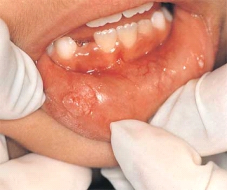 <strong> The illustration shows an oral condyloma acuminatum presenting in a child. The presence of condyloma acuminatum in a child suggests:</strong> A) hypersensitivity. B) genetic predisposition. C) sexual abuse. D) autoimmune disease.