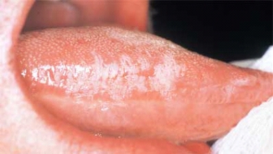 <strong> The most reliable method of diagnosis for this condition of the tongue is the isolation of the Epstein-Barr virus.</strong> A) White hairy tongue B) Hairy leukoplakia C) Mononucleosis D) Kaposi sarcoma