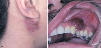 <strong> Name the vascular lesion that is seen in this illustration. The patient is HIV seropositive. The most common intraoral locations are the gingiva and palate. When diagnosed, this vascular lesion meets the criteria for the diagnosis of acquired immune deficiency syndrome (AIDS). The most common locations are the gingiva and palate.</strong> A) Non-Hodgkin lymphoma B) Kaposi sarcoma C) Thrombocytopenia D) Hemangioma