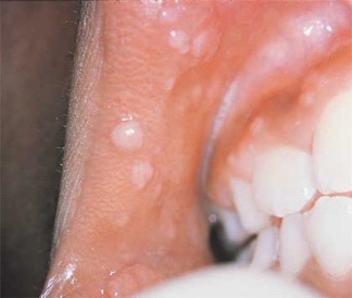 <strong> Which of the lesions seen in this illustration is the lesion seen LEAST commonly in HIV patients?</strong> A) Candidiasis B) Hairy leukoplakia C) Herpes simplex D) Heck disease