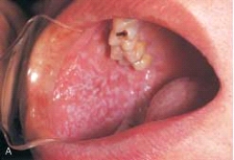 <strong> The classic appearance of this condition is a patterrn of interconnecting slender lines referred to as Wickham striae.</strong> A) Lichen planus B) Linea alba C) Erythema multiforme D) Reiter syndrome