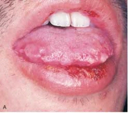 <strong> The onset of this condition is explosive. It is characterized by skin and mucosal lesions. The skin lesions are referred to as target, iris, or bull's eye lesions. The mucosal lesions affect the buccal mucosa, lips, and tongue and appear as superficial ulcerations. The lip lesions are ulcerated, encrusted, and bloody. On the basis of this description, you suspect:</strong> A) lichen planus. B) erythema multiforme. C) contact dermatitis. D) SLE.