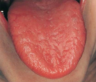 <strong> This patient has Sjögren syndrome and severe xerostomia. Which of the following is the clinical feature that most appropriately describes the changes on the tongue in this patient?</strong> A) Dryness B) Candidiasis C) Loss of filiform and fungiform papillae D) Fissures
