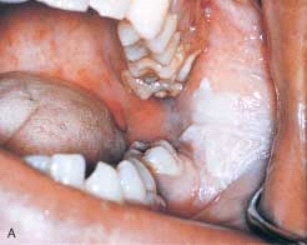 <strong> This patient comes to the office as an emergency. The patient complains of a toothache in the left mandibular posterior area. On clinical examination you notice a gray-to-white patch on the left posterior buccal mucosa. On questioning the patient tells you that this area is also painful. After reviewing the patient's medical history, you question the patient regarding his recent use of:</strong> A) hydrogen peroxide. B) aspirin. C) antibiotics. D) mouthwash.