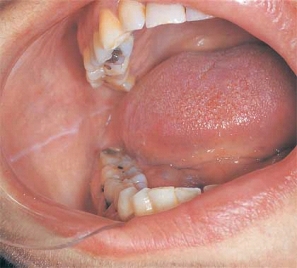 <strong> This white raised line observed anterior-posterior on the buccal mucosa along the occlusal plane is:</strong> A) cheek biting B) linea alba. C) white sponge nevus. D) frictional keratosis.