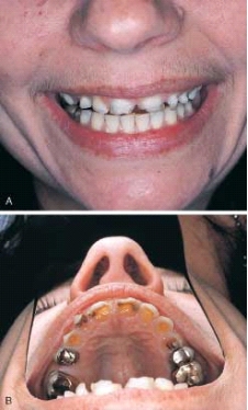 <strong> This type of erosion is classically associated with:</strong> A) anorexia nervosa. B) bulimia. C) sucking lemons. D) abrasive toothpaste.