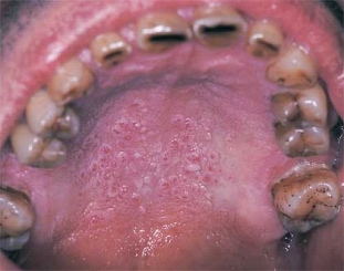 <strong> This lesion on the palate typically is associated with heavy pipe and cigar smoking.</strong> A) Tobacco pouch keratosis B) Necrotizing sialometaplasia C) Nicotine stomatitis D) Frictional keratosis