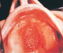 <strong> This granular, erythematous papillary surface of the palatal vault was caused by:</strong> A) poor oral hygiene. B) an ill-fitting suction area of the denture. C) the denture flange. D) soaking the denture in caustic rinses.