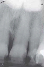 <strong> This bony hard radiopaque structure in the midline of the hard palate is genetic and autosomal dominant. The diagnosis is made through clinical diagnosis. You suspect a:</strong> A) palatal cyst. B) torus palatinus. C) mixed tumor. D) ranula.