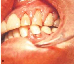 <strong> The gingival enlargement in this patient was caused by a calcium channel blocker. Which one of the following would likely be the cause?</strong> A) Dilantin B) Cyclosporine C) Procardia D) Clozapine