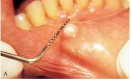 <strong> The base of this lesion would be described as:</strong> A) pedunculated. B) a lobule. C) a bulla. D) sessile.