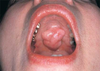 <strong> This torus palatinus would be described as:</strong> A) bullous. B) a papule. C) lobulated. D) a nodule.