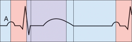 <strong>What is happening during the phase labeled A? </strong> A) Semilunar valve closure B) AV valve closure C) Atrial depolarization D) Ventricular repolarization