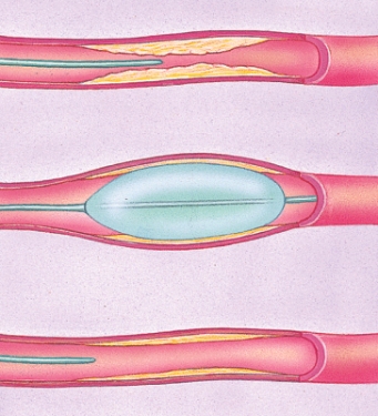 <strong>What is the name of this procedure? </strong> A) By-pass surgery B) Placement of a stent C) Balloon angioplasty D) Defibrillation