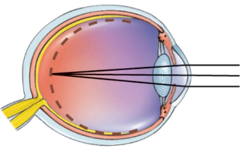 <strong>What is this a picture of? </strong> A) Nearsightedness B) Farsightedness C) Astigmatism D) Normal vision