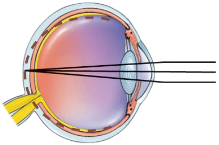 <strong>What is this a picture of? </strong> A) Nearsightedness B) Farsightedness C) Astigmatism D) Normal vision