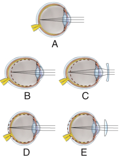 <strong>Which one represents nearsightedness before being corrected? </strong> A) A B) B C) C D) D E) E