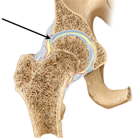 Which of the following statements is FALSE regarding this structure? A) It is called the acetabular labrum. B) It is composed primarily of fibrocartilage. C) It contributes to the stability of the hip joint. D) It is enclosed within the articular capsule. E) It is a bony lip that extends around the head of the femur.