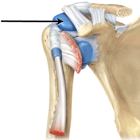 <strong>Identify this structure. </strong> A) subdeltoid bursa B) subcoracoid bursa C) subscapular bursa D) subacromial bursa E) suprapatellar bursa