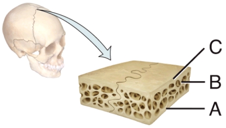 <strong>In the diagram of a suture joint, where is the spongy bone? </strong> A) A B) B C) C D) Both A and C E) Both A and B