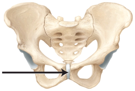 <strong>In the diagram, which type of joint is represented? </strong> A) suture B) syndesmosis C) symphysis D) cartilaginous E) synovial
