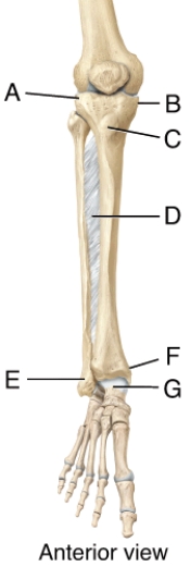 In the diagram of the tibia and fibula, this structure forms the prominence on the lateral surface of the ankle.
