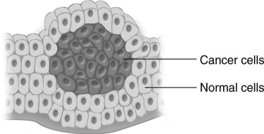   The tumor shown in the figure above is most likely malignant.