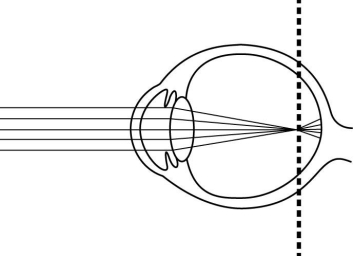 The figure above is a diagram of an eye with an abnormality that would result in vision problems. A person with this condition would be considered farsighted and would require convex lenses in order to see objects in the distance.