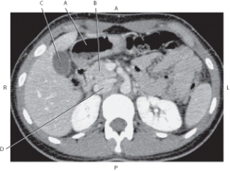 <strong>The following questions refer to the figure below of an axial CT of the abdomen. Which line points to the head of the pancreas?</strong> A) A B) B C) C D) D