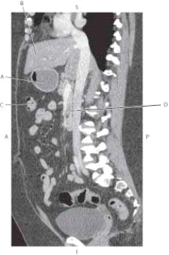 <strong>The following questions refer to the figure below of a sagittal CT reformat of the abdomen. Which line points to the stomach?</strong> A) A B) B C) C D) D
