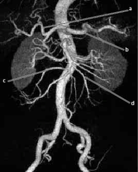 <strong>The following questions refer to the figure below of a 3D CTA of the abdominal aorta and branches. Which line is pointing to the right colic artery?</strong> A) A B) B C) C D) D
