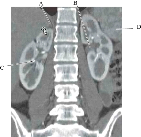 <strong>The following questions refer to the figure below of a coronal CT reformat of the abdomen. Which line is pointing to the left renal pelvis?</strong> A) A B) B C) C D) D