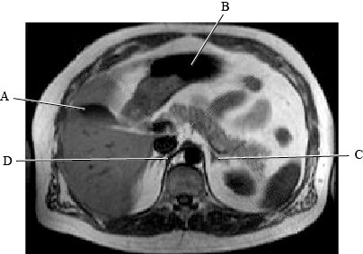 <strong>The following questions refer to the figure below of an axial, T1-weighted MRI of the abdomen. Which line is pointing to the gallbladder?</strong> A) A B) B C) C D) D