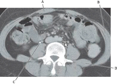 <strong>The following questions refer to the figure below of an axial CT of the abdomen. Which line is pointing to the quadratus lumborum muscle?</strong> A) A B) B C) C D) D