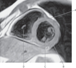 <strong>In the figure below of a short-axis, T1-weighted MRI of the heart, which line points to the left ventricle? </strong> A) A B) B C) C D) D