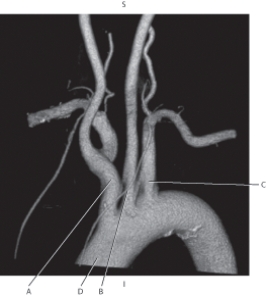 <strong>The following questions refer to the figure below of a 3D CT of the aortic arch. Which line points to the left common carotid artery?</strong> A) A B) B C) C D) D
