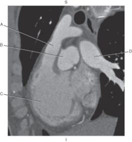 <strong>The following questions refer to the figure below of CT reformat of the right ventricular outflow tract. Which line points to the right ventricle?</strong> A) A B) B C) C D) D