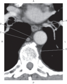<strong>The following questions refer to the figure below of an axial CT of the mediastinum. Which line points to the hemiazygos vein?</strong> A) A B) B C) C D) D