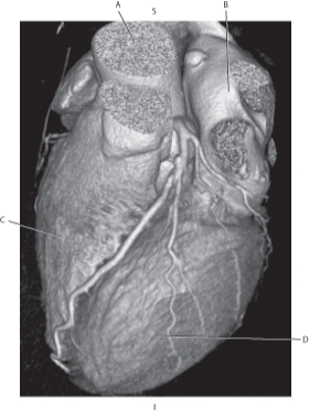 <strong>The following questions refer to the figure below of a 3D CT of the heart. Which line points to the left atrium?</strong> A) A B) B C) C D) D