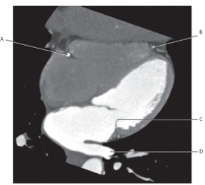 <strong>The following questions refer to the figure below of a horizontal long axis CT. Which line points to the right coronary artery?</strong> A) A B) B C) C D) D