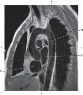 <strong>The following questions refer to the figure below of a sagittal, T1-weighted MRI of the heart. Which line points to the right atrium?</strong> A) A B) B C) C D) D