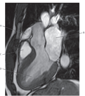 <strong>The following questions refer to the figure below of a T2-weighted MRI of the left ventricular outflow tract. Which line points to the left ventricle?</strong> A) A B) B C) C D) D