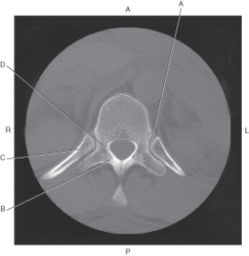 <strong>The following questions refer to the figure below of an axial CT of the thoracic vertebra. Which line points to the pedicle?</strong> A) A B) B C) C D) D