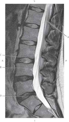 <strong>The following questions refer to the figure below of a sagittal, T2-weighted MRI of the lumbar spine. Which line points to the nucleus pulposus?</strong> A) A B) B C) C D) D